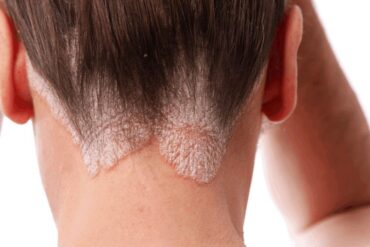 Cukrzyca a skóra i włosy