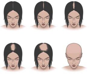 Łysienie plackowate 5 najczęstszych przyczyn – Trycholog Garwolin