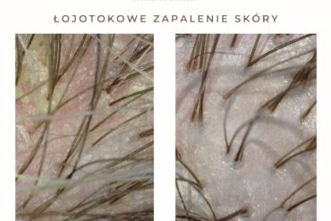 Kruszące, łamiące się włosy? | Trycholog Garwolin