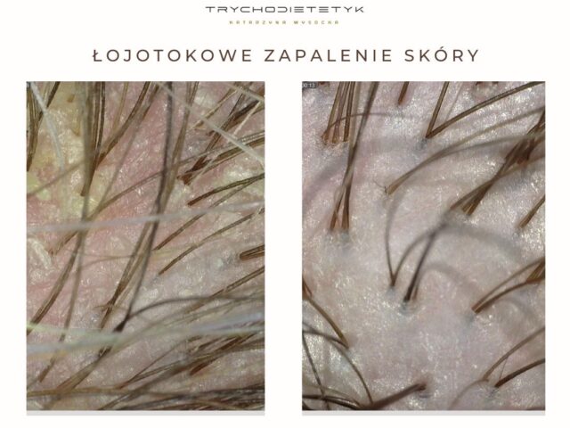 łojotokowe zapalenie skóry